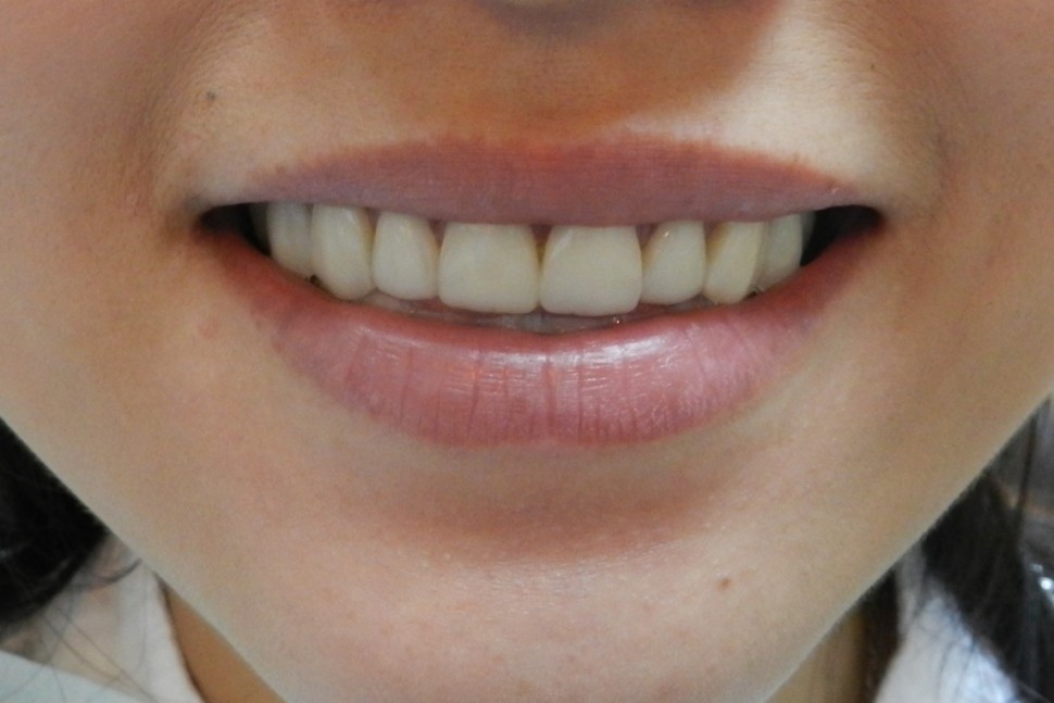 Porcelain Veneers Yap & Associates Dental Surgery, Kuala Lumpur, Malaysia