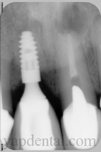 X-Ray of an Implant