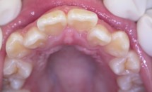 Orthodontic patient # 1: Before
