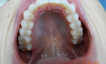 Invisalign Patient Upper Dentition