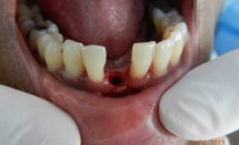 Implant: lower incisor#1.2