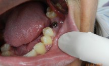 Implant molar #2.1