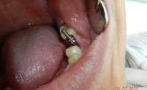 Implant molar #2.2