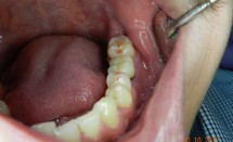 Implant molar #2.5