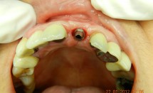 Implant incisor #3.2