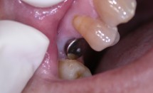 Implant premolar#1.1