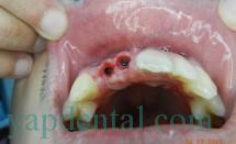 Implant incisors #4.0