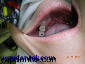 Molar implant