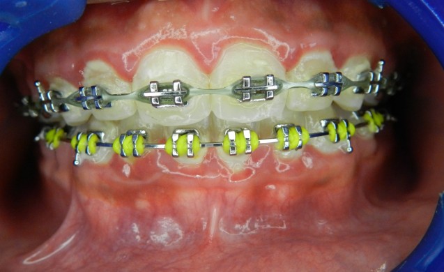 Orthodontic Treatment: Braces