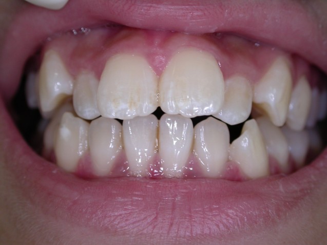 Orthodontic Treatment: Patient 1 Before