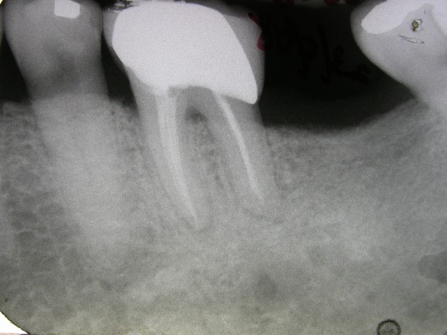 X-Ray: Root Canal Treatment