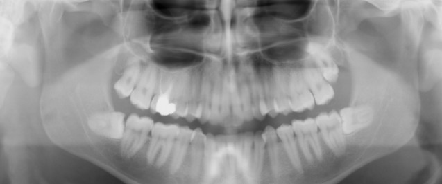 X Ray of an Impacted Wisdom