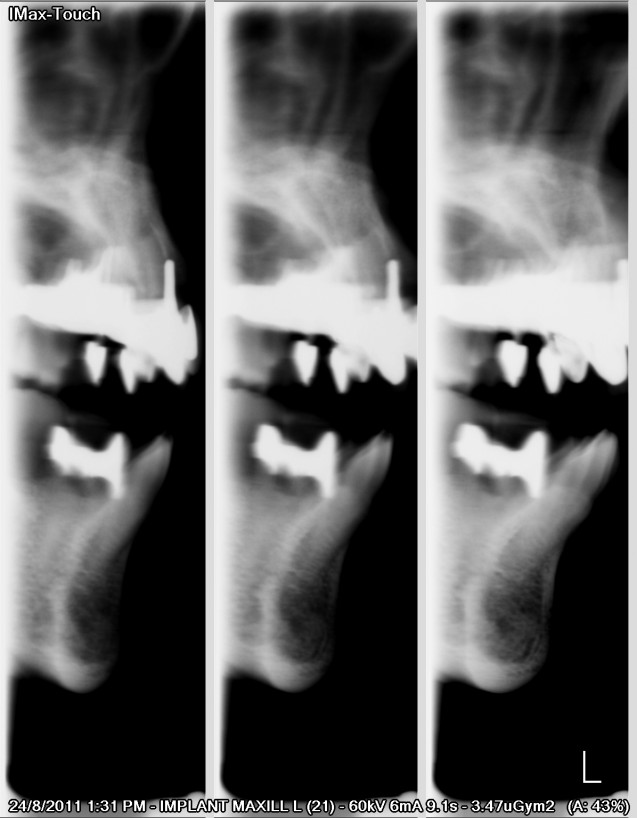 Implant X-Ray