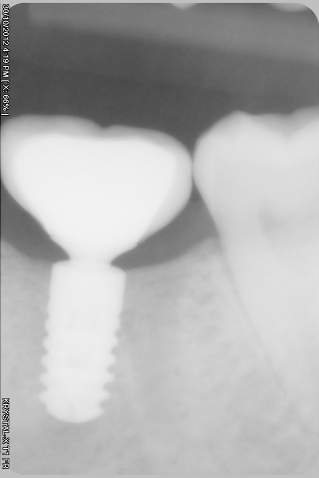 X-Ray: Implant