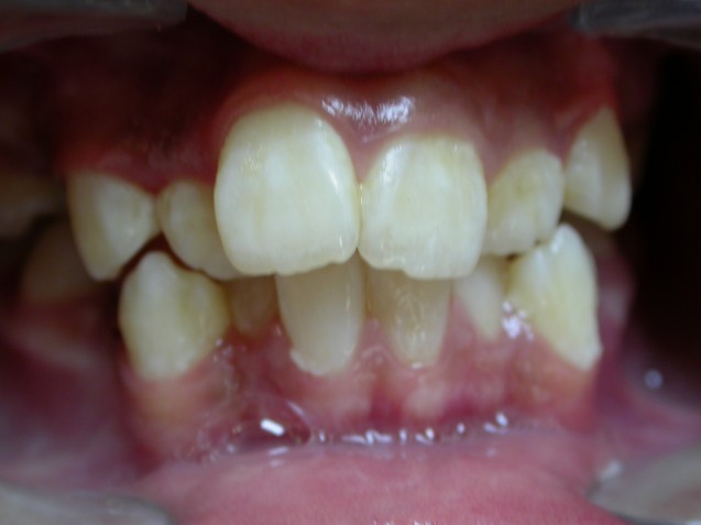 Orthodontic patient #2: Before