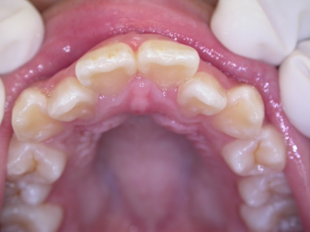 Orthodontic patient # 1: Before