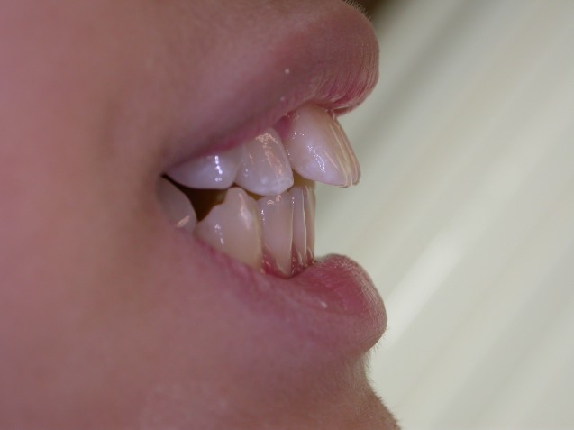 Orthodontic Treatment