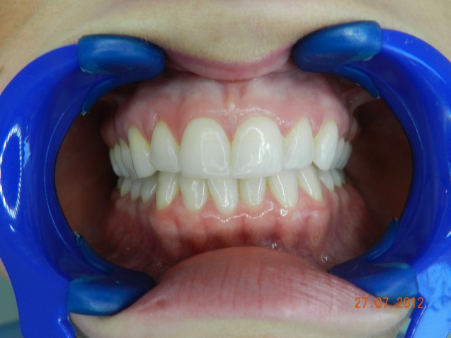 Invisalign Patient Outcome