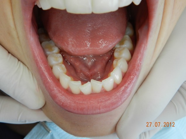 Invisalign Patient Lower Dentition