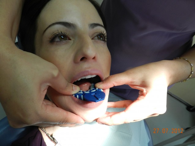 Invisalign Patient Treatment
