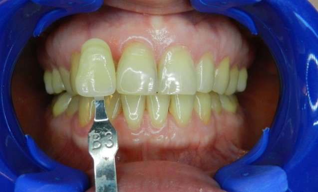 BriteSmile: Patient 1 Before