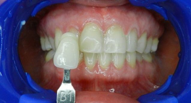 BriteSmile: Patient 1 After