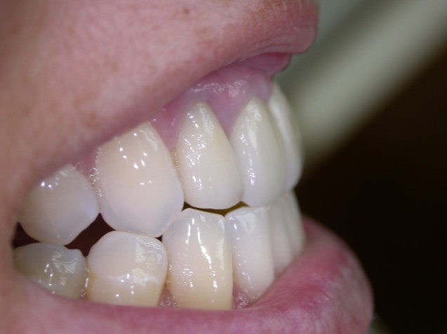 Implant