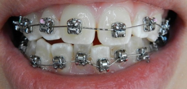 Orthodontic Treatment: Braces
