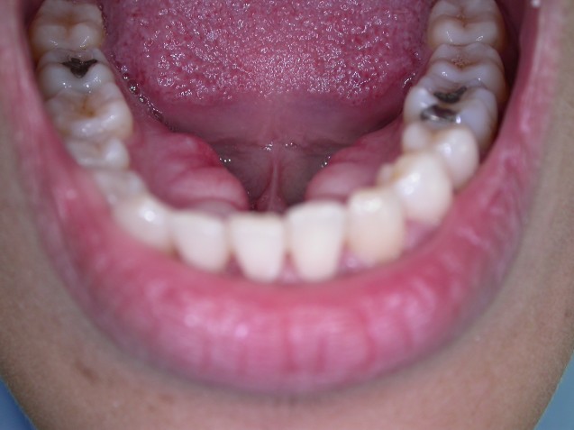 Fillings