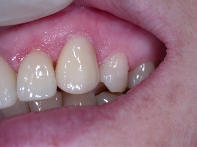EMax crown