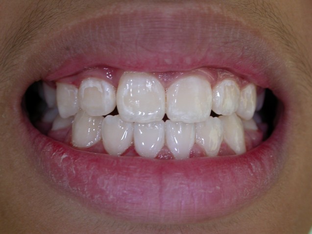 Orthodontic patient #2: After