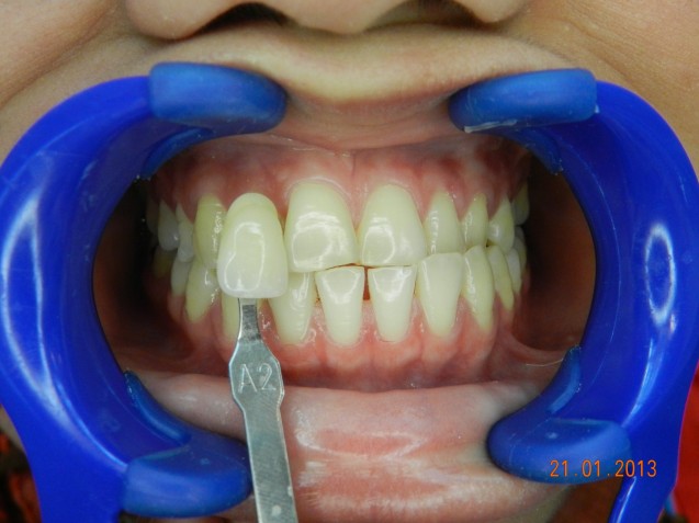 BriteSmile: Patient 2 Before