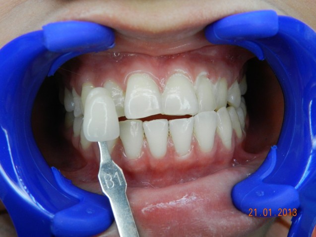 BriteSmile: Patient 2 After