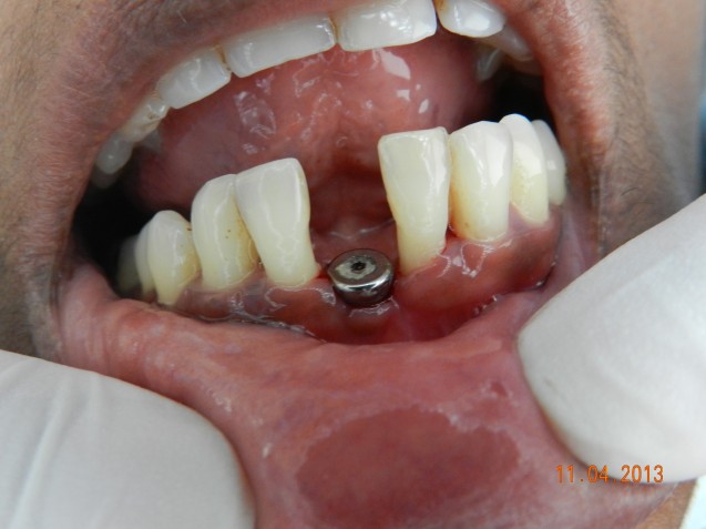 Implant : lower incisor #1.1
