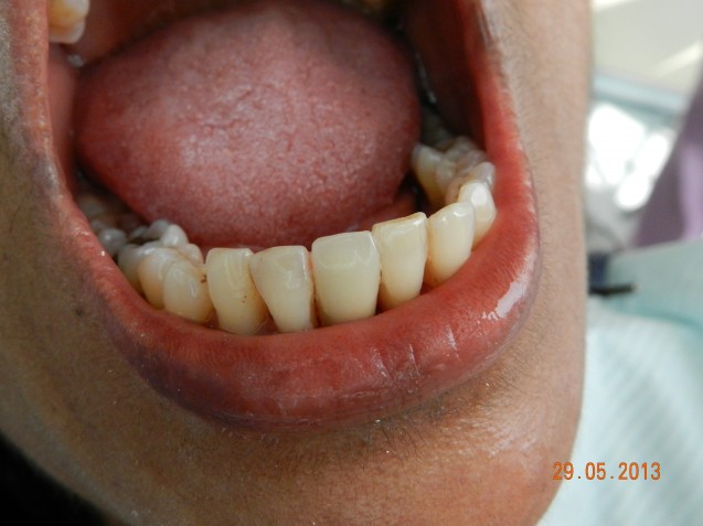 Implant: lower incisor #1.3