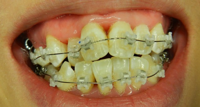 Orthodontic Treatment: Braces with Porcelain Brackets