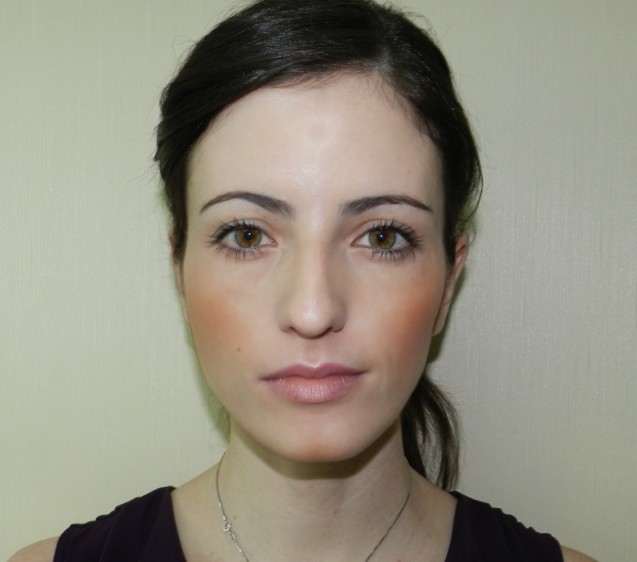 Invisalign Patient: Dani Maia