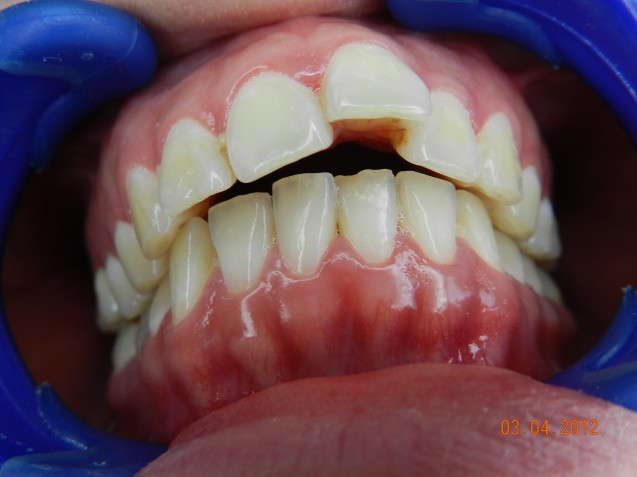 Invisalign patient #2 before