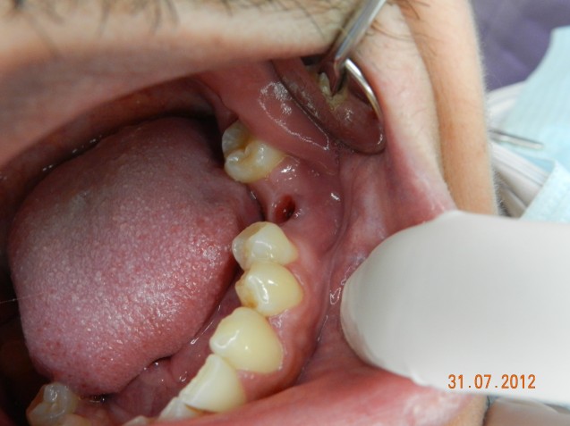 Implant molar #2.3