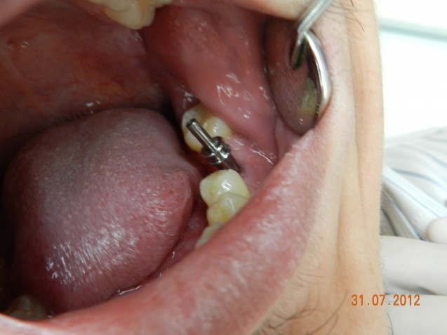 Implant molar #2.2