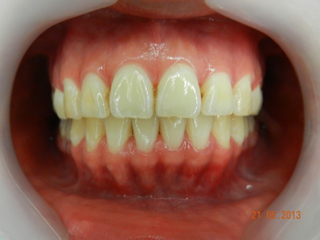 Invisalign patient #2, after