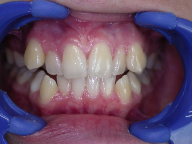 Orthodontics patient #3 before