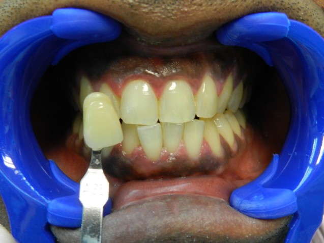 Brite Smile patient #3: before