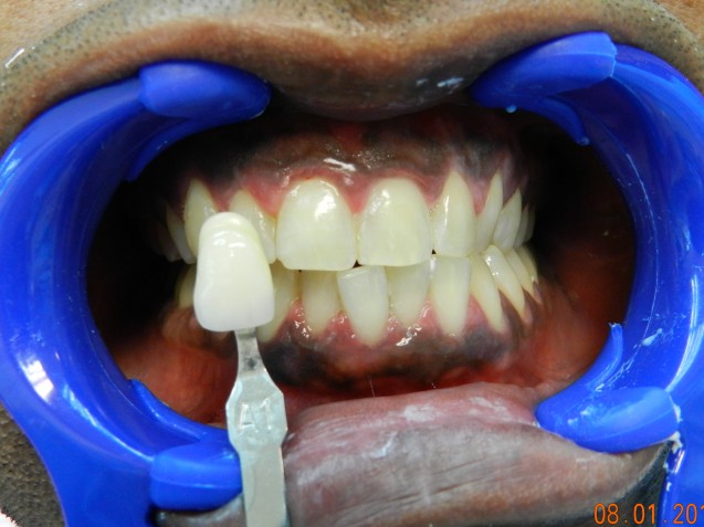 Brite Smile patient #3 after