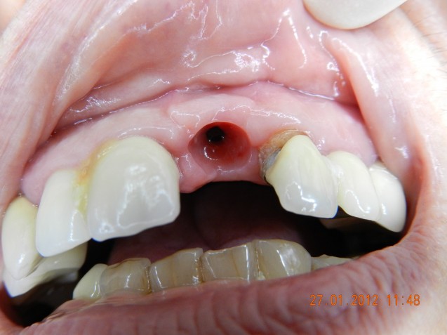 Implant incisor #3.1