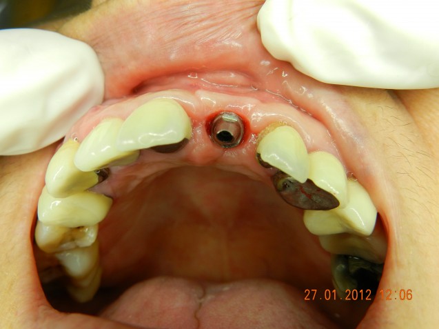 Implant incisor #3.2