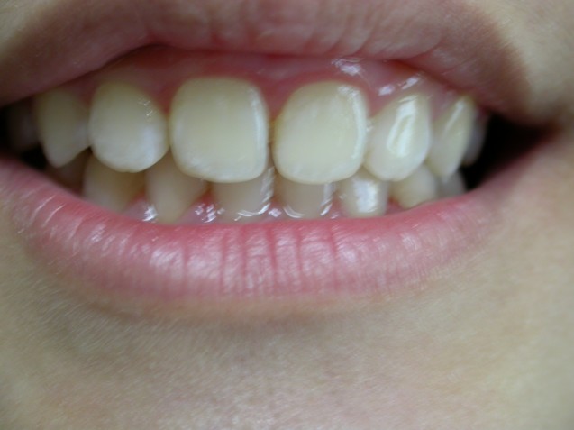 Ortho Smile #7