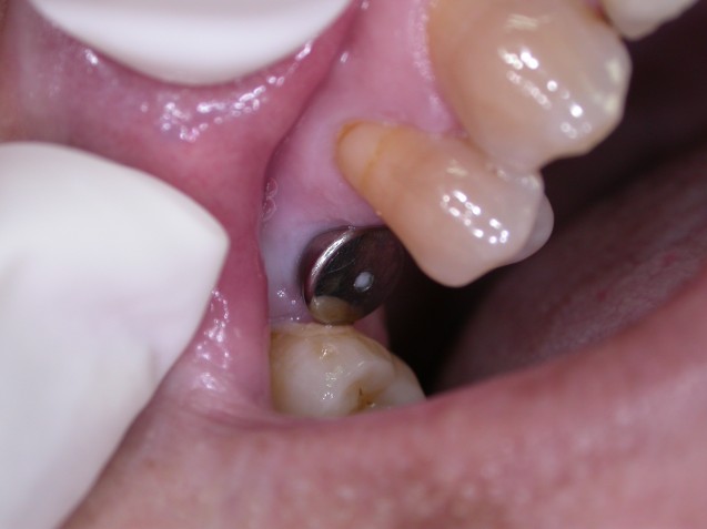 Implant premolar#1.1