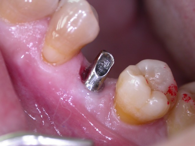 Implant premolar #1.2
