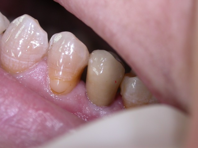 Implant premolar  #1.3